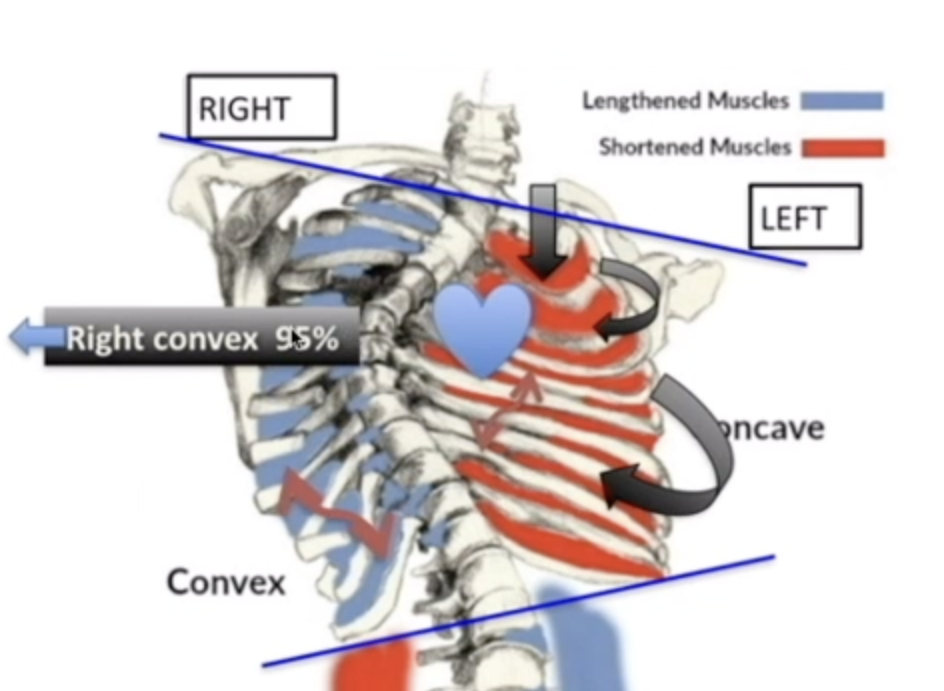 12-HOUR MASSAGE THERAPY FOR SPINAL CURVATURES (Pre-recorded Webinar)